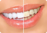 Как в домашних условиях отбелить зубы?